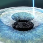 SMILE Eye Surgery: A Minimally Invasive Laser Vision Correction Explained
